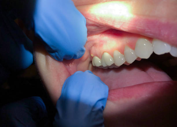 Best Emergency Dentist for Lost Fillings or Crowns in Washington, IL
